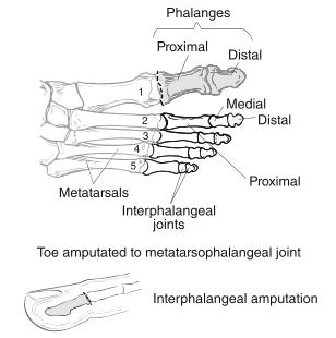 Wiki - Why Doesn't A Partial Toe Amputation Require -52? | Medical ...